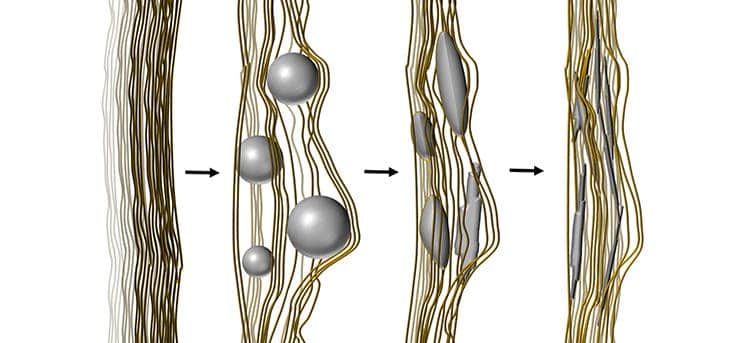 n: Strings of a polymerised liquid crystal act as the strings of collagen in the body. The amorphous calcium phosphate (in grey) enters the strings and begins to crystallise, creating the artificial bone-like material. ​ ​Illustration: Anand Kumar Rajasekharan/Chalmers University of Technology.