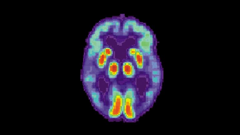 A PET scan of the brain of a person with Alzheimer’s disease. Image credits: National Institute on Aging.