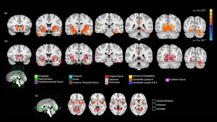 Regions showing significantly greater gray matter volume in the brains of teens who had tried cannabis. Credit: Orr et al., JNeurosci (2019).
