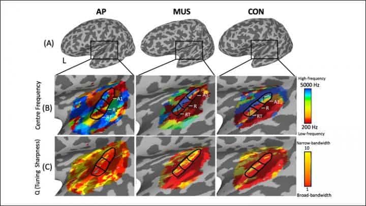 Individuals with absolute pitch (AP) had a more active auditory cortex than non-AP individuals. Credit: McKetton et al., JNeurosci.