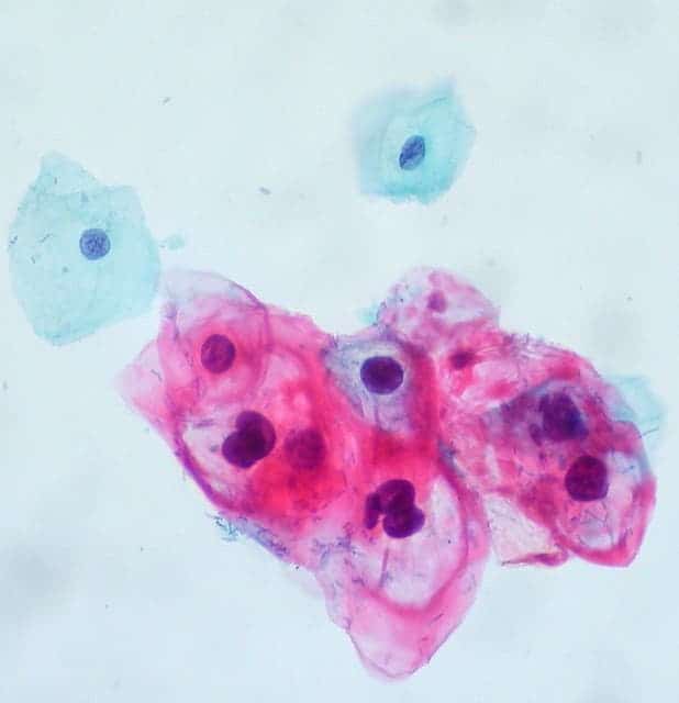 HPV-infected cells (bottom right). Image credits: Ed Uthman.