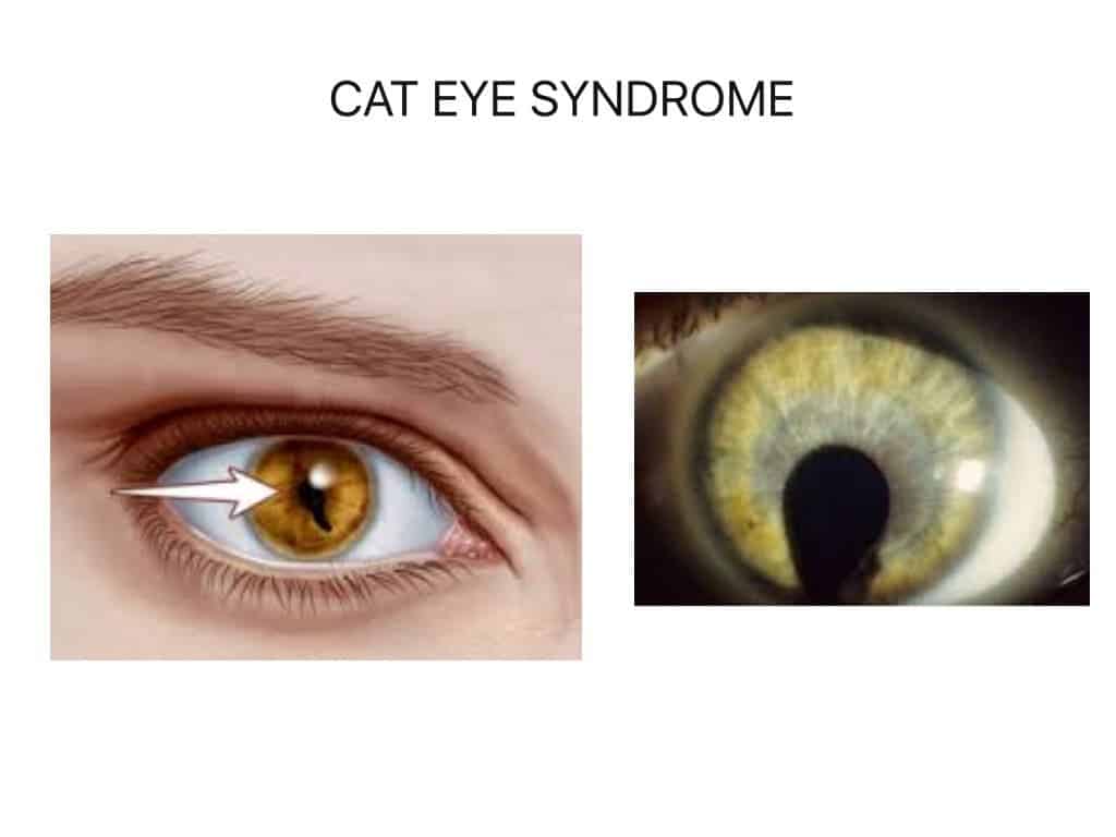 What Is Cat Eye Syndrome Here S What The Science Says
