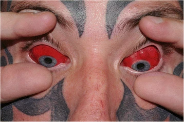 Models Botched Eyeball Tattoo The Dangers of Sclera Tattooing  Live  Science