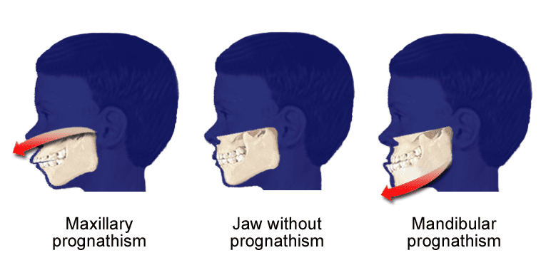 Maxillary and mandibular prognathism.