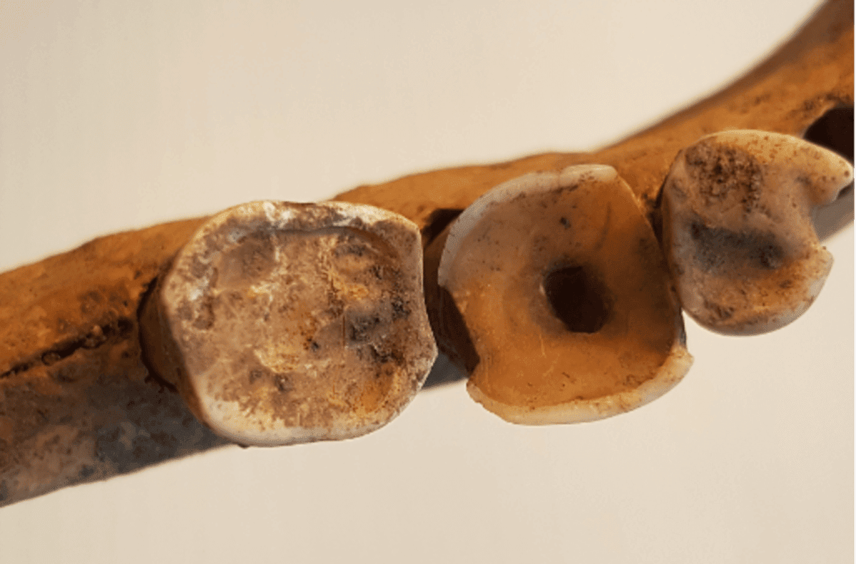 Ancient viking teeth