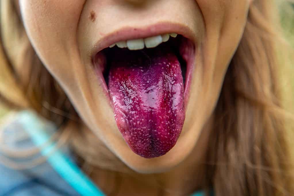 Tongue purple from candy.